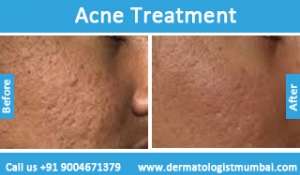 Acne treatment for face pimples before and after photos result