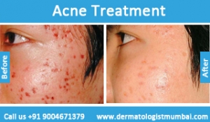 Acne treatment for face pimples before after photos