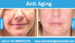 Anti Ageing Treatment for Face Wrinkles - Anti AgingPatient Before After Photo Results