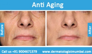 Anti Ageing Treatment for Face Wrinkles - Patient Before After Photo Results