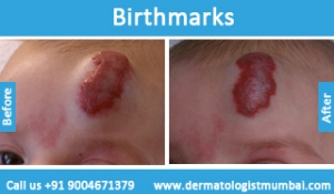 birthmarks removal treatment before after photos in mumbai