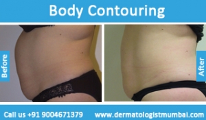 body contouring treatment before after photos in mumbai india