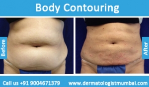 body contouring treatment before after photos