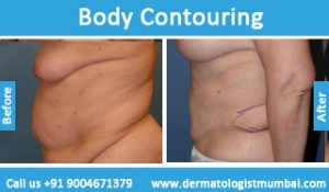 body contouring treatment before and after photos Mumbai
