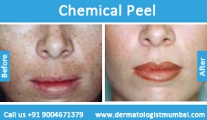 chemical skin peeling treatment before and after photos