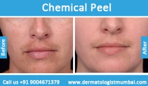 chemical skin peeling treatment before and after photos mumbai