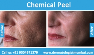 chemical skin peeling treatment before after photos in mumbai