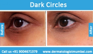 dark circles treatment before and after photos mumbai