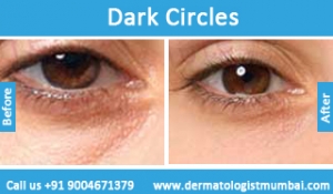 dark circles treatment before and after photos mumbai