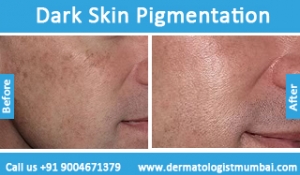 dark skin pigmentation treatment before after photos in mumbai india