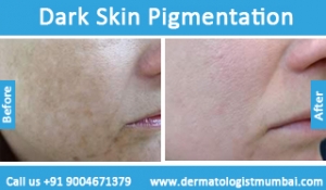 dark skin pigmentation treatment before after photos in mumbai