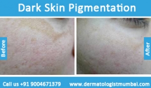 dark skin pigmentation treatment before after photos