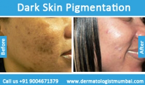 dark skin pigmentation treatment before and after photos