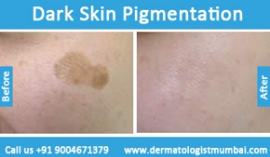 dark skin pigmentation treatment before and after result photos