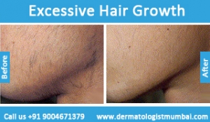 excessive hair growth treatment before after photos in mumbai india