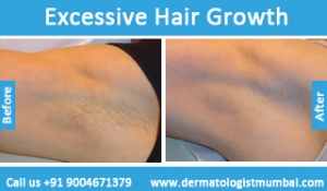 excessive hair growth treatment before and after photos in mumbai