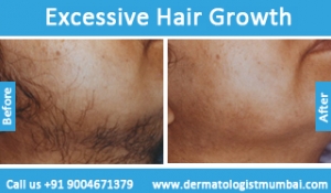 excessive hair growth treatment before and after photos Mumbai