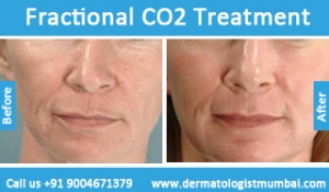 fractional co2 laser treatment before and after photos