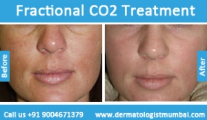 fractional co2 laser treatment before and after results