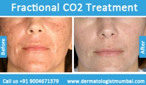 fractional co2 laser treatment before and after photos Mumbai