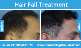 Best Hair Transplant Surgery Side Effects Cost in Mumbai India