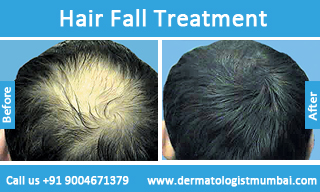 Best Hair Loss Treatment Cost, Hair Fall Doctor in Mumbai, India