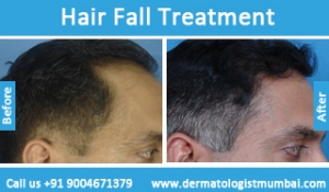 hair loss treatment before after photos in mumbai india
