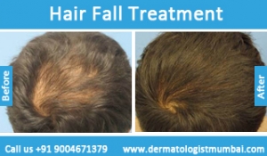 hair loss treatment before after photos