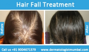hair loss treatment before after result photos