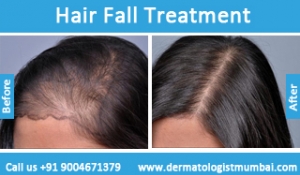 hair loss treatment before and after result mumbai