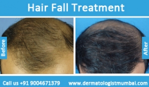 hair loss treatment before after result