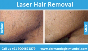 laser hair removal treatment before after photos in mumbai india