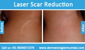 laser scar reduction treatment before after photos in mumbai india