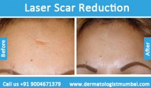 laser scar reduction treatment before after photos in mumbai