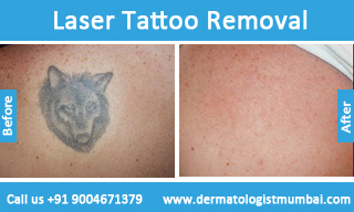 Tattoo Removal Cost in India  Pristyn Care