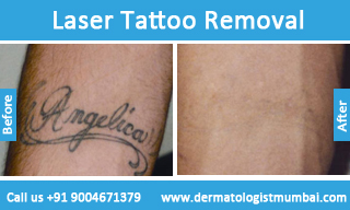 Reducing the Cost of Tattoo Removal How to Maximize Your Laser Tattoo  Removal Treatments Results  Reflections Center