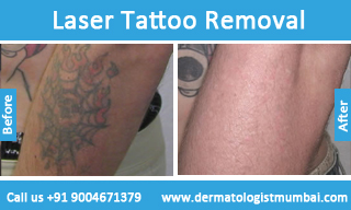 Best Laser Tattoo Removal Treatment in Mumbai with Latest Prices  Top  Laser Tattoo Removal specialists Near Me in Mumbai  SkinGenious May 2022