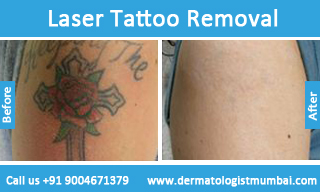 Aesthetic Solutions Mumbai India  Tattoo Removal Lasers can remove  tattoos by breaking up the pigment colors with a high intensity light beam  The laser works on breaking the tattoo ink making