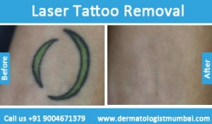 laser tattoo removal treatment before after photos in mumbai india