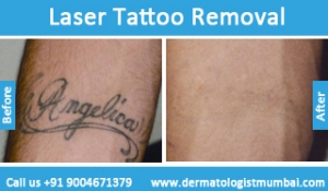 laser tattoo removal treatment before after photos in mumbai