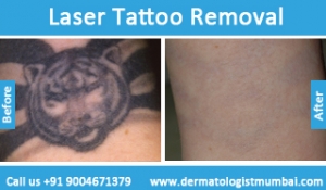 laser tattoo removal treatment before and after photos in Mumbai