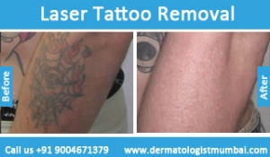 laser tattoo removal treatment before and after results