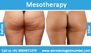 mesotherapy treatment before and after photos in Mumbai India