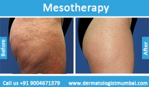 mesotherapy treatment before after photos in Mumbai India