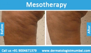 mesotherapy treatment before and after photos in Mumbai