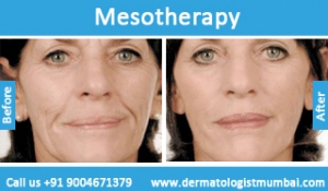 mesotherapy treatment before and after result