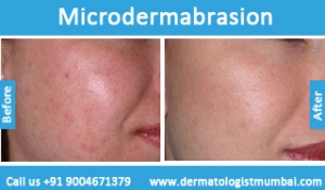 microdermabrasion treatment before after photos in Mumbai