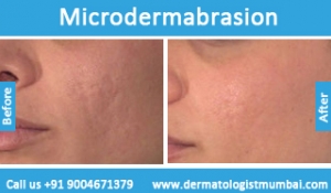 microdermabrasion treatment before after photos