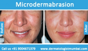 microdermabrasion treatment before and after photos