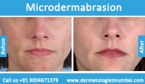 microdermabrasion treatment before and after photos